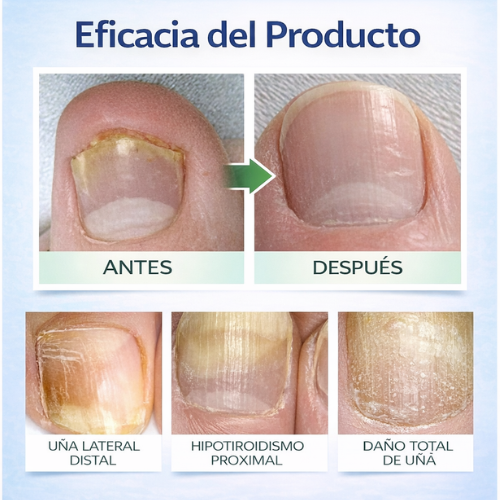 NailPatch Restaurador - 21 Parches AntiHongos - Recupera La Belleza y Fuerza De Tus Uñas